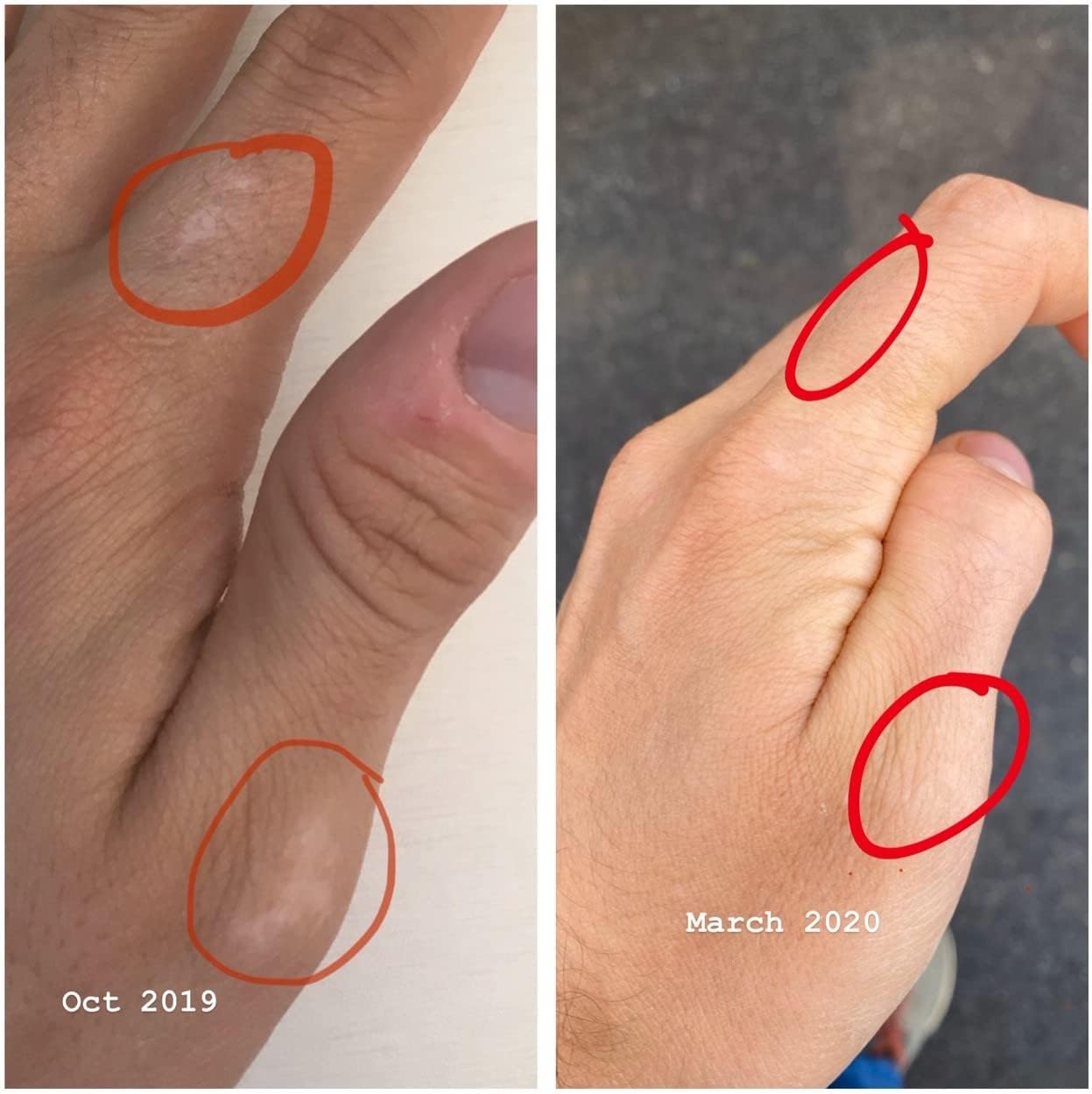 Recouleur Vitiligo Supplement: Vitamin and Mineral Blend for Skin Pigmentation Support - 6 Month Supply