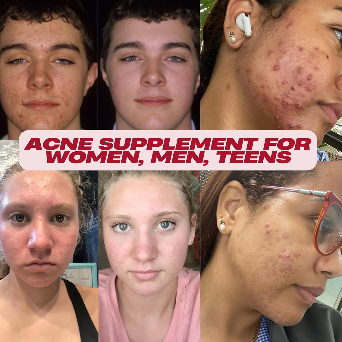 Acnetame Acne Pills – Vitamin Supplements for Acne Treatment – Natural Clear Skin – 60 Tablets – Canada - görsel 2